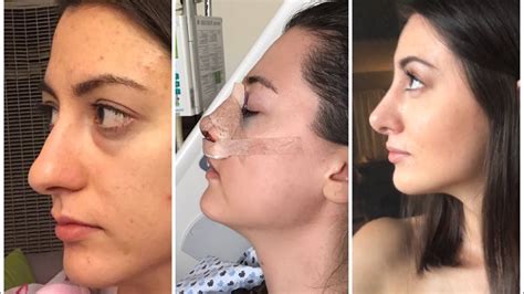 1  6 months after rhinoplasty | month by month nose job ...