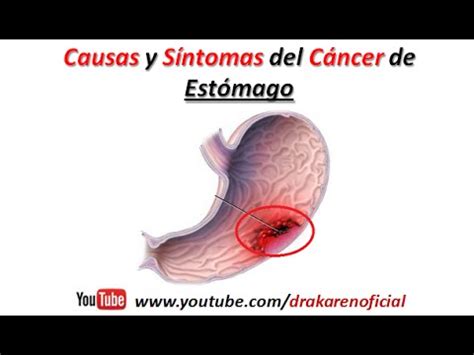 1.Cancer de Estomago: Causas y sintomas del Cancer de ...