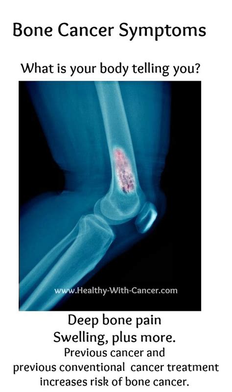 10 best Bone Cancer images on Pinterest | Bone cancer ...