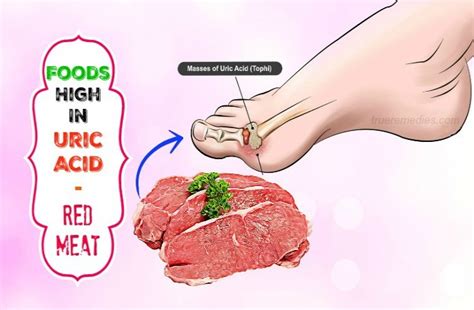10 Gout Causing Foods High In Uric Acid To Avoid