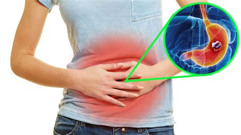 10 Síntomas del Cáncer de Estómago que DEBES Conocer