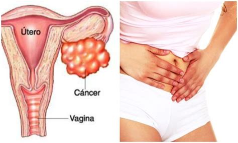 10 Sintomas del cáncer de ovario