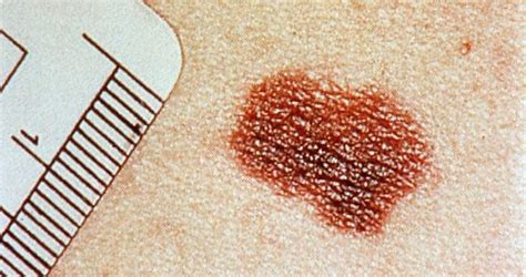 10 tipos de manchas en la piel y cómo identificarlas