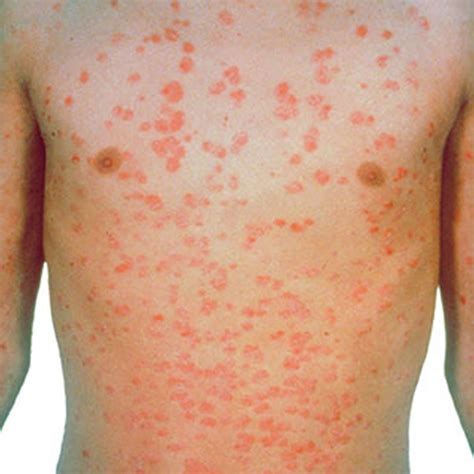 100+ [ 10 Psoriasis Triggers And How ] | Foods In Your ...