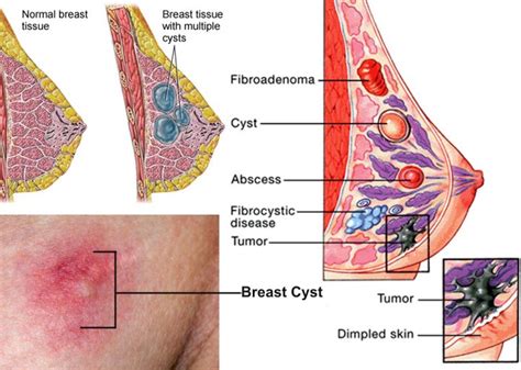 1000+ images about Breast Cysts/Breast Cancer or signs of ...