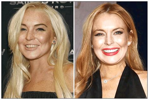 101 Celebrities Before and After Plastic Surgery – Starfluff