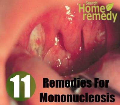 11 Home Remedies For Mononucleosis   Natural Treatments ...