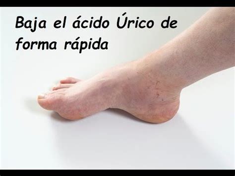 13 best images about ACIDO URICO para disminución on ...