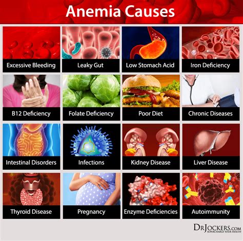 13 Ways to Heal Anemia Naturally   DrJockers.com