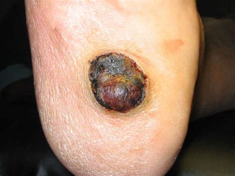 14. tumores de piel   I parte