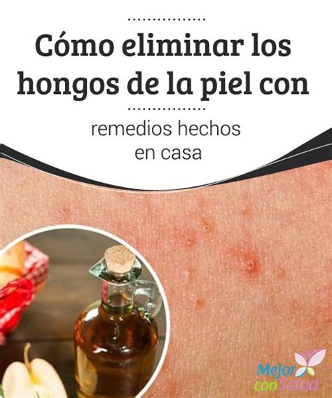 152 best images about re.edios caseros on Pinterest | Aloe ...