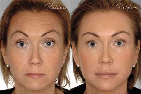 17 Best images about Botox Before and After on Pinterest ...