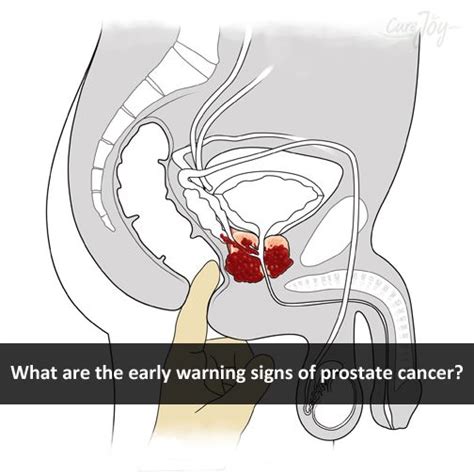19 best images about prostrate on Pinterest | Different ...