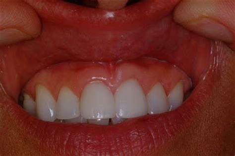 1st signs of mouth cancer Images   Frompo   1