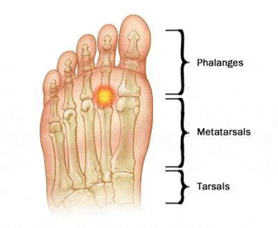 20 mejores imágenes de Ankle/ Foot Therapy en Pinterest ...