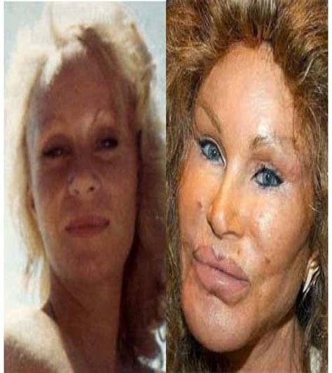 20 Of The Worst Celebrity Plastic Surgery Disasters