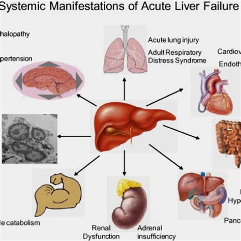 24 best images about End Stage Liver Disease on Pinterest ...