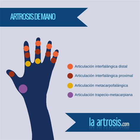 3 ejercicios para prevenir la artrosis de manos ...
