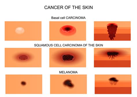 3 Skin Cancer Types and Their Warning Signs   University ...