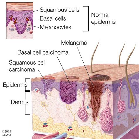 3 types of #skincancer: basal cell carcinoma, squamous ...