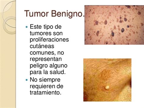 39 tumores cutáneos benignos