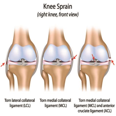 43 best Knee Injuries & Knee Brace Arthritis images on ...