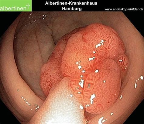 46 best images about Polyps, Colon on Pinterest | Survival ...