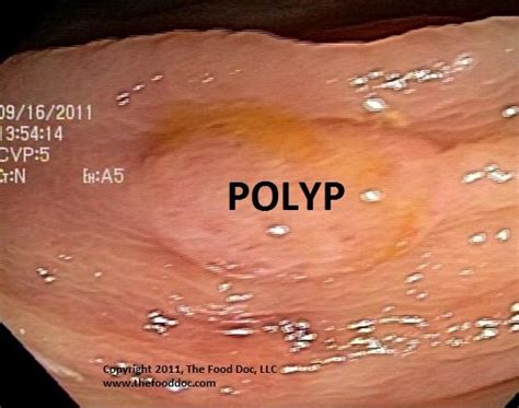 46 best images about Polyps, Colon on Pinterest | Survival ...