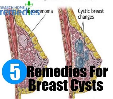 48 best images about Breast Cysts/Breast Cancer or signs ...