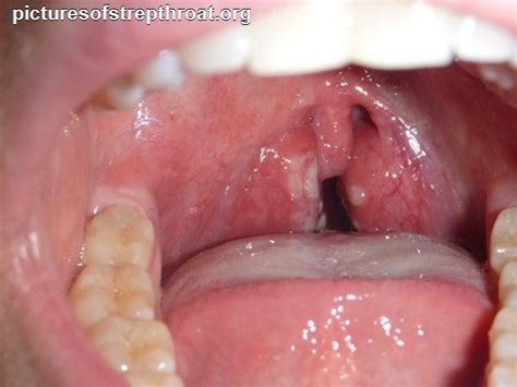 49 best images about Strep Throat on Pinterest | Pictures ...
