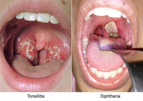 5 Essentials You Must Know About Diphtheria