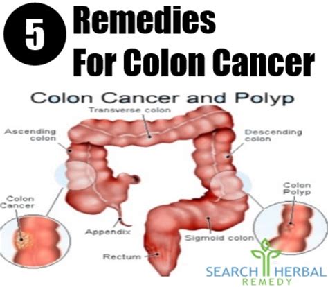 5 Remedies For Colon Cancer   Colon Cancer Treatment ...