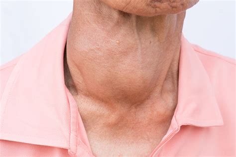 5 síntomas de que padeces hipertiroidismo   Vida Lúcida