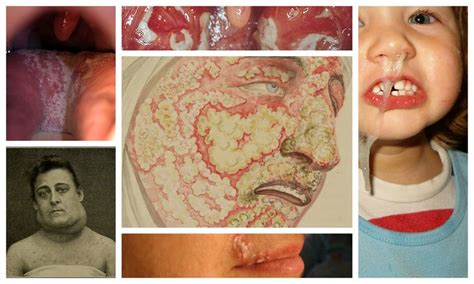 6 enfermedades transmitidas por la saliva | Marcianos