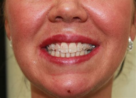 6 Month Smile Braces Putney | Fast Teeth Straightening London