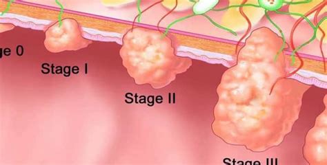 7 claves sobre los pólipos en el colon y el cáncer