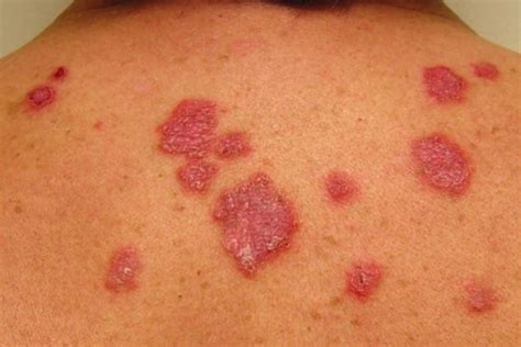 7 enfermedades que causan manchas rojas en la piel