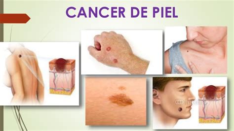 7 Primeros síntomas de cáncer que el 90% de personas ...