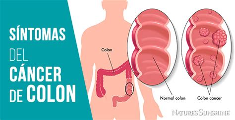 7 síntomas del cáncer de colon que las mujeres no deben ...