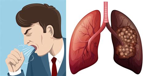7 síntomas del cáncer de pulmón   Conocer Salud