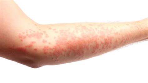 7 Tipos de enfermedades de la piel que no conocias
