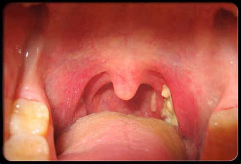 8 Causes of White Spots On Tonsils That You Need to Know ...
