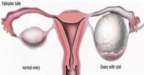 8 Easy Ways to Shrink Your Ovarian Cysts Naturally