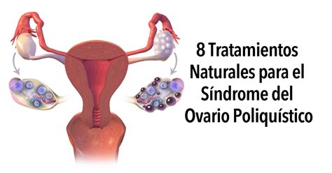 8 Tratamientos naturales para el Síndrome del ovario ...