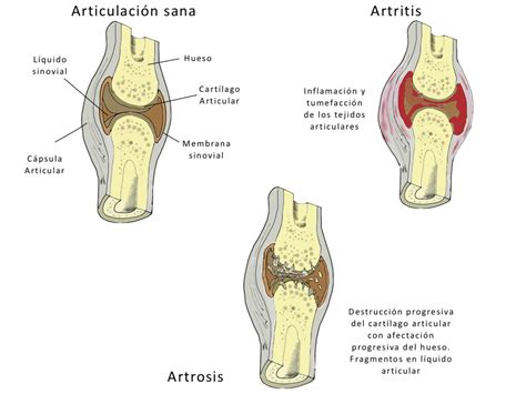 83+ [ Diferencias Entre Artritis Y Artrosis ]   Me Duelen ...