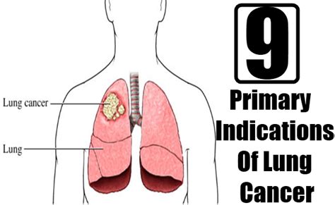 9 Primary Indications Of Lung Cancer | Top DIY Health ...