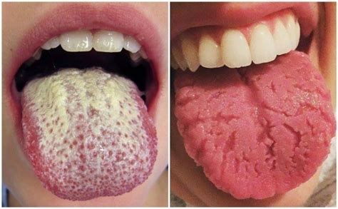 9 Señales de ALERTA que tu lengua te está enviando ¡No las ...
