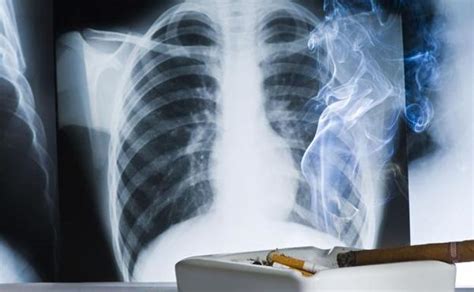 9 síntomas que te alertan de un inicio de cáncer de pulmón ...