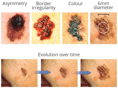 9 Steps To Check For Skin Cancer | Womans Vibe