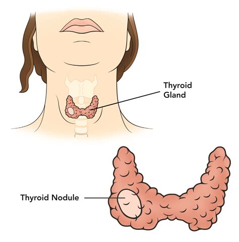 A brief description about the Thyroid Nodules Symptoms ...